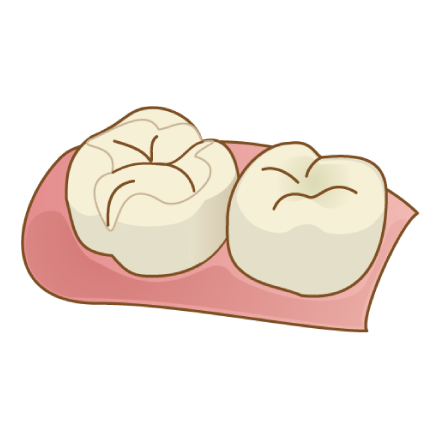 ポーセレンインレー